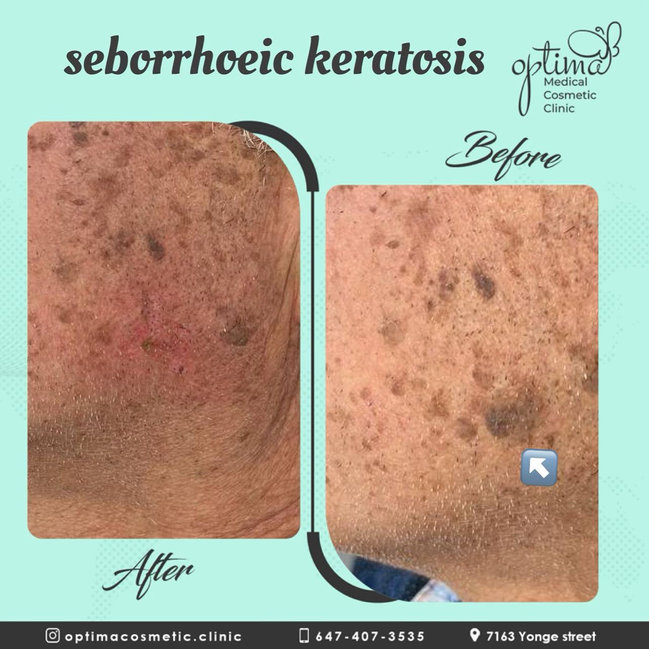 Seborrheic Keratosis Treatment And Care By Optima Medical Cosmetic 